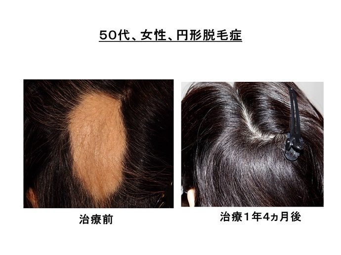 円形脱毛症　病院